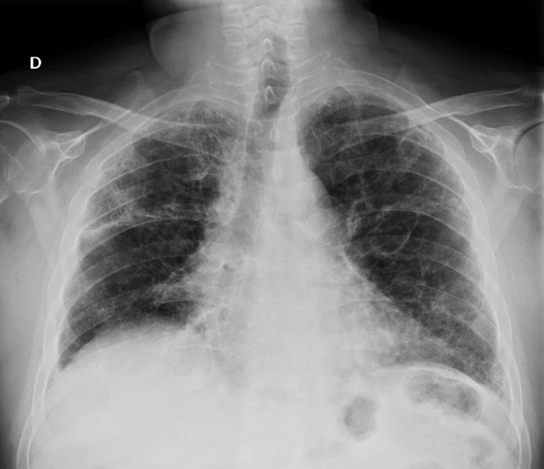 Desafíos en el manejo de la fibrosis pulmonar post-COVID-19 para la población latinoamericana